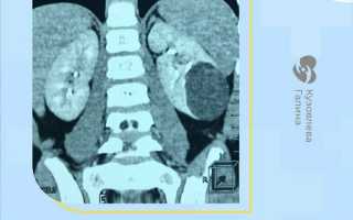 Киста почки у ребенка