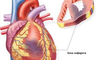 Инфаркт миокарда у детей