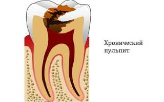 Как избавиться от хронического фиброзного пульпита: клиническая картина и лечение