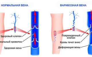 Симптомы варикоза ног у женщин, степень опасности и методы лечения этого заболевания