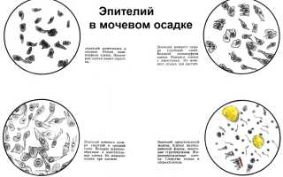 Что делать, если обнаружен плоский эпителий в моче у ребенка?