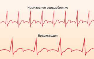 Почему бывает низкий пульс при нормальном давлении и что нужно делать человеку в этом случае?