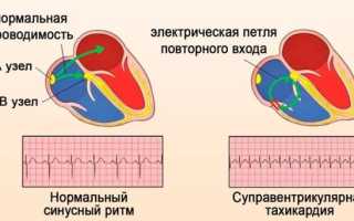 Симптомы пароксизмов наджелудочковой тахикардии, их ЭКГ-признаки и лечение