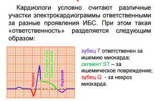 ЭКГ при ишемической болезни сердца