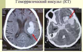 Всё о геморрагическом инсульте: что это такое, симптомы, лечение, последствия, сколько живут после него