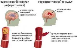 Опасный инсульт: признаки, первая помощь, последствия и профилактика