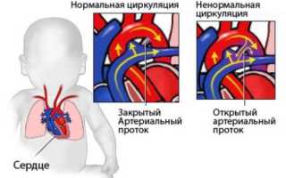 Порок сердца у детей