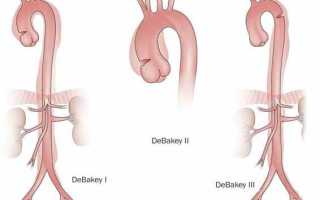 Расслоение аорты — причины и механизм развития, виды патологии и ее лечение