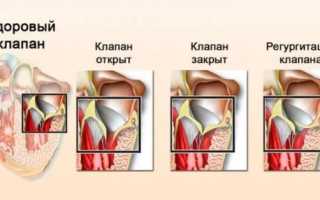 Пролапс митрального клапана 2 степени с регургитацией: симптомы, лечение, необходимые физические нагрузки, возможность службы в армии