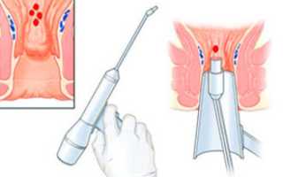 Операция по удалению анальной трещины