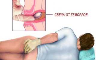 Используем свечи от геморроидальных узлов