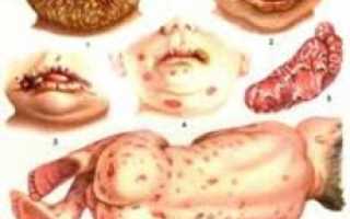 Сифилис у детей – внутриутробное инфицирование