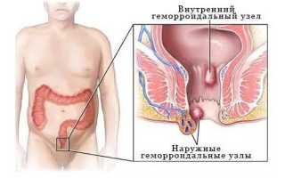 Взаимосвязь геморроя и простатита