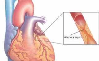Атеросклероз коронарных артерий
