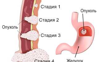 Рак желудка у детей (карцинома)