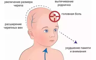 Повышенное внутричерепное давление у ребенка