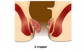 Изучим геморрой второй степени