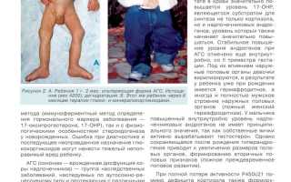 Адреногенитальный синдром у детей