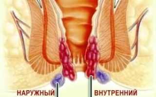 Что такое геморроидальный тромбоз?