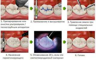 Герметизация зубов у детей – как происходит и сколько стоит