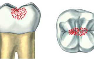 Особенности устранения поверхностного кариеса: симптомы и лечение