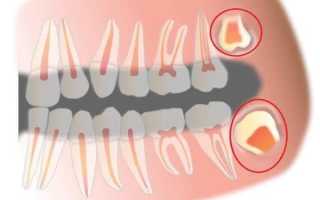 Что собой представляют зубы мудрости и каким заболеваниям они подвержены: краткий обзор