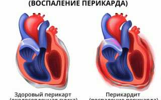 Методы диагностики и лечения перикардита у детей