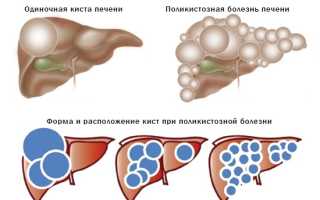 Как лечить кисту печени у ребенка?