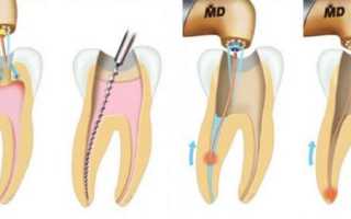 Воспалился зубной нерв: что делать в домашних условиях