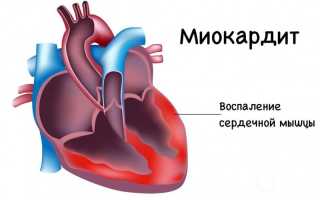 Миокардит у детей – как лечат заболевание сердца?