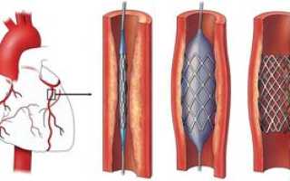 Методы хирургического лечения ИБС