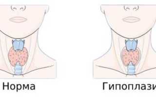 Гипоплазия щитовидной железы у детей