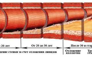 Атеросклероз сосудов: механизмы развития и симптомы атеросклероза