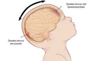Сотрясение мозга у ребенка