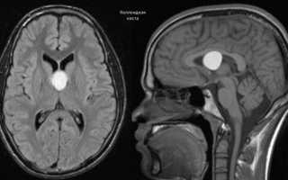 Киста головного мозга у ребенка