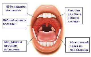 Лечение герпесной ангины у детей