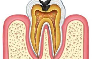 Что такое пульпит и как можно избавиться от недуга