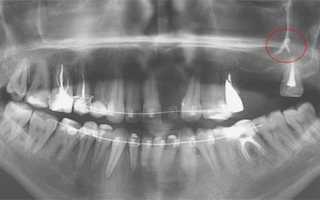 Болит зуб после чистки каналов: почему и что делать