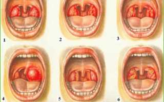 Виды ангины у детей и методы лечения