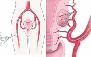 Эмболизация маточных артерий — как и когда проводится, последствия процедуры