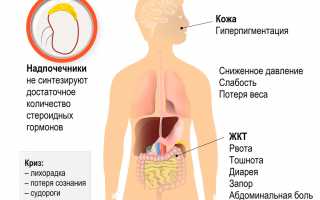 Болезнь Аддисона у детей – надпочечниковая недостаточность