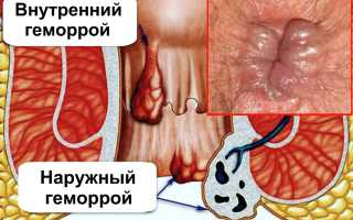 Используется кора дуба от геморроя