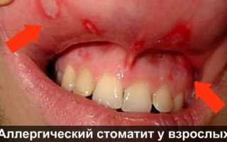 Проявления и методы лечения аллергического стоматита: как справиться с проблемой