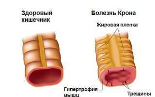 Болезнь Крона у детей – чем опасна и как ее лечить?