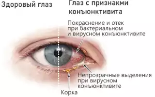 Бактериальный конъюнктивит у ребенка