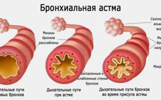 Лечение астмы у детей в Израиле