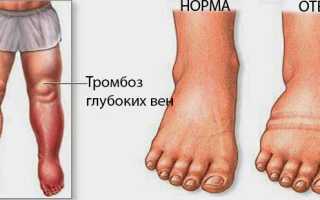 6 причин, почему отекают ноги у мужчин: патологические и физиологические факторы