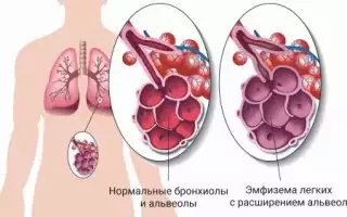 Эмфизема легких у детей
