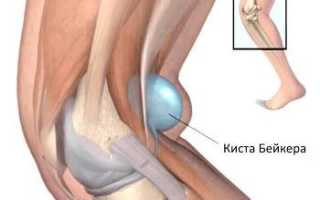 Киста Бейкера у детей – доброкачественное образование коленного сустава