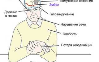 Симптомы и клинические рекомендации по лечению ишемии сосудов головного мозга